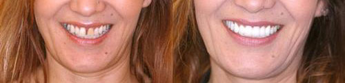 veneers